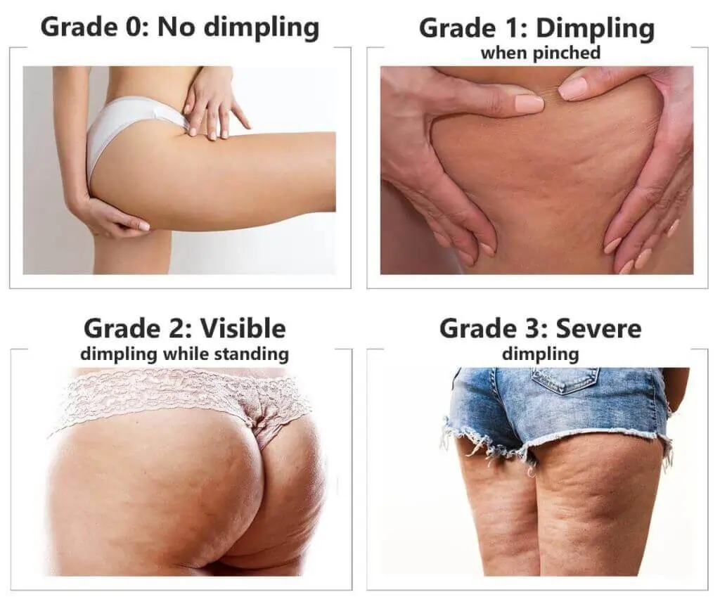 Representation of the stages of cellulite development East Sussex